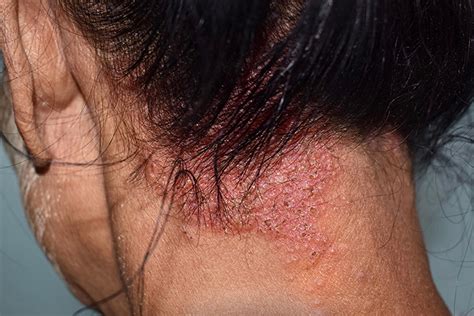 Qué es la Dermatitis Seborreica o caspa El médico interactivo