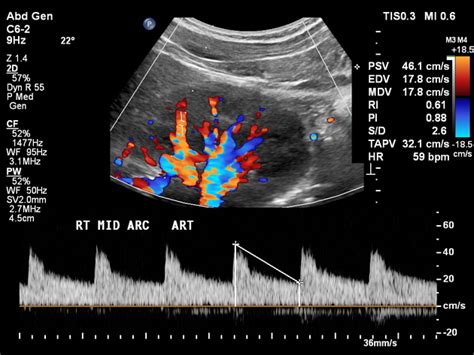 Normal Kidney Ultrasound