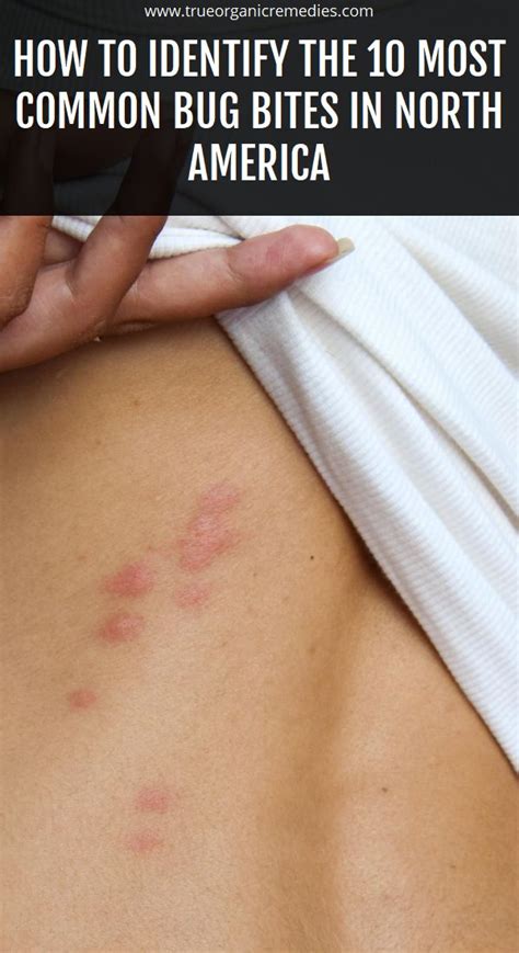 How To Identify The 10 Most Common Bug Bites In North America Bug Bites Ant Bites Bug Bites