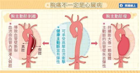 For faster navigation, this iframe is preloading the wikiwand page for 主動脈剝離. 照護線上》保養血管要趁早，心血管疾病問題多 - 自由評論網