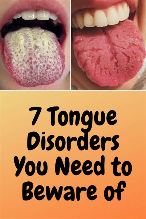 7 Tongue Disorders You Need To Beware Of