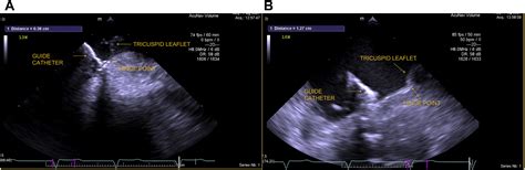 A Novel Imaging Approach In Tricuspid Cardioband In Valve Positioning