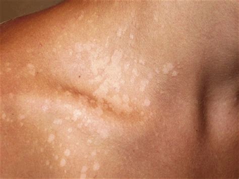 This fungus, called malessizia furfur, is a type of yeast that naturally. Tinea Versicolor | Symptoms Causes Treatment and ...