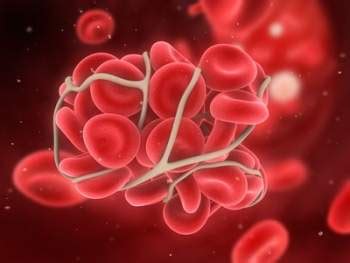 As a result, blood cells may break and leak blood into. Thrombose erkennen
