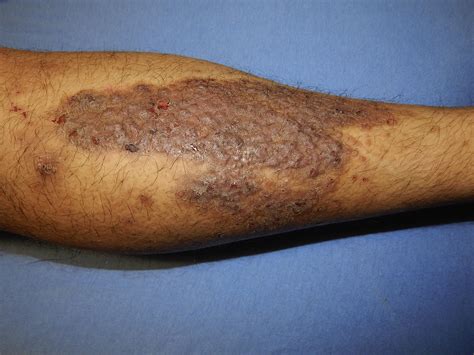 Man With Bumps On His Shin Annals Of Emergency Medicine