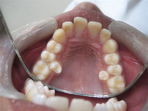 Rare Combination Of Paramolar And Distomolar Supernumerary Teeth In A