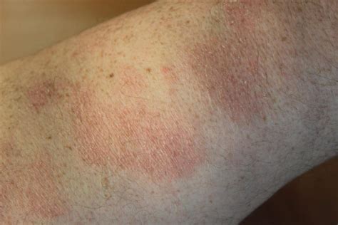 Chronic Superficial Scaly Dermatitis Syn Parapsoriasis Digitate