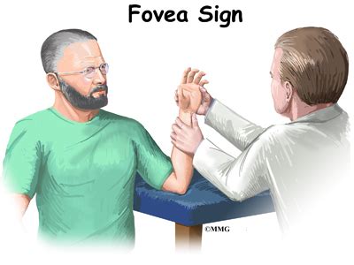 The triangular fibrocartilage complex (tfcc) is formed by the triangular fibrocartilage discus (tfc), the radioulnar ligaments (ruls) and the ulnocarpal ligaments (ucls). Triangular Fibrocartilage Complex (TFCC) Injuries ...