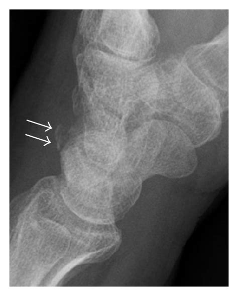 Dorsal Triquetral Fracture Of The Left Wrist In A 30 Year Old Man After