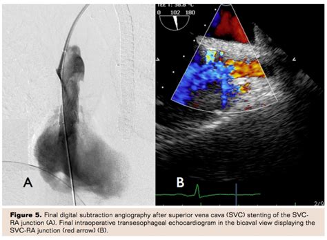 Endovascular Stenting Of The Superior Vena Cava Right Atrial Junction