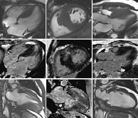 Cmr Images In Different Phenotypes Of Hcm Typical Asymmetric Septal