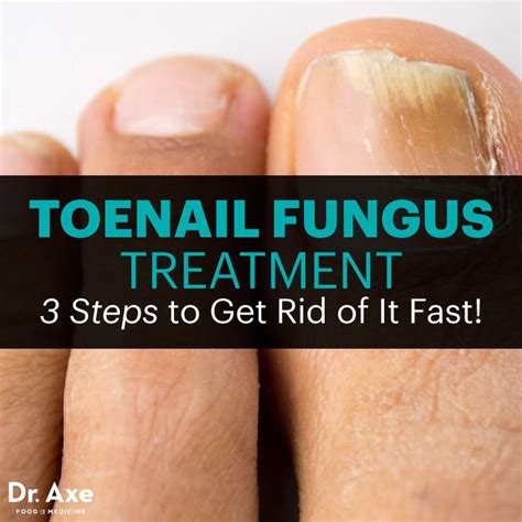 Best 25 Toenail Fungus Treatment Ideas On Pinterest Toenail Fungus