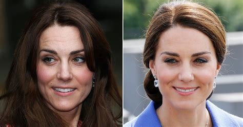 Did Kate Middleton Have Cosmetic Surgery Celebrity