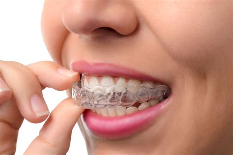 Ortodoncia Invisible Y Removible Con F Rula Invisalign