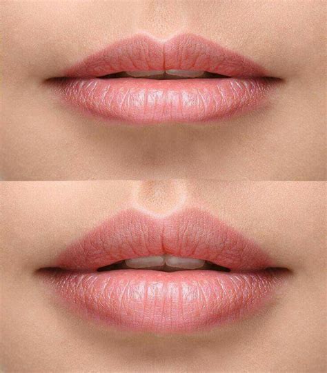 Before And After Lip Filler Get Pouty And Perfect Lips Safely And Easily