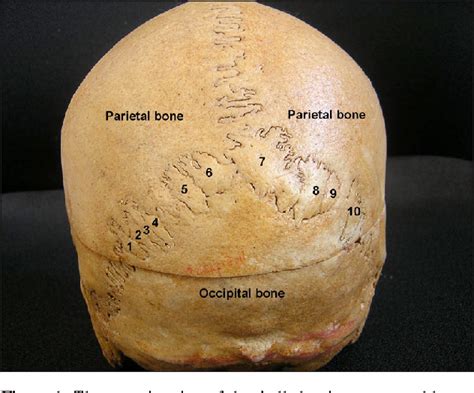Figure 1 From Multiple Wormian Bones At The Lambdoid Suture In An