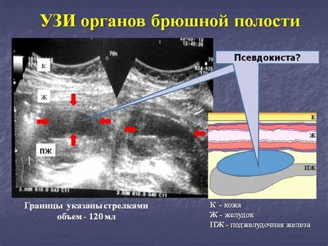 Диета жирового панкреонекроза Сочетанное применение инновационных миниинвазивных технологий в лечении Сочетанное применение инновационных миниинвазивных технологий в лечении Диета жирового панкреонекроза