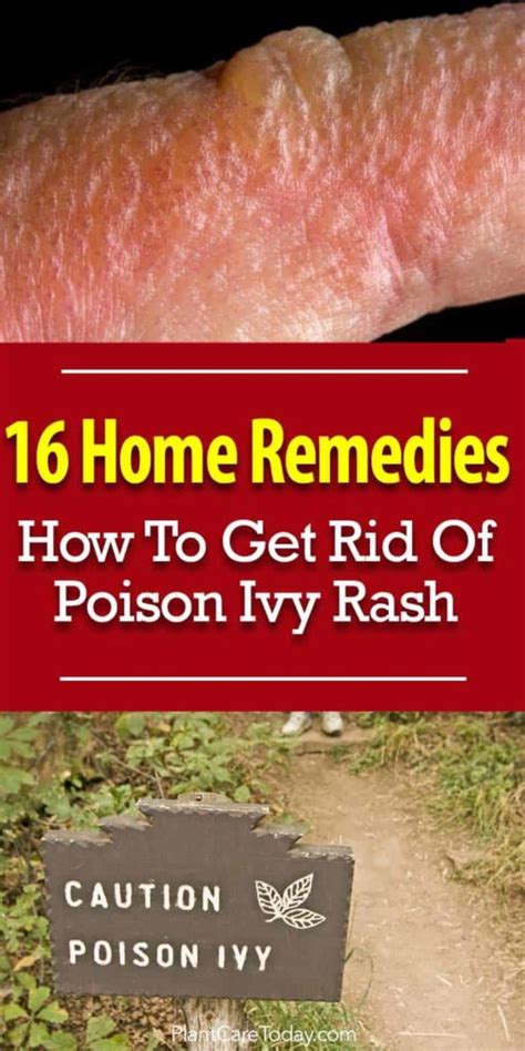 16 Home Remedies How To Get Rid Of Poison Ivy Rash