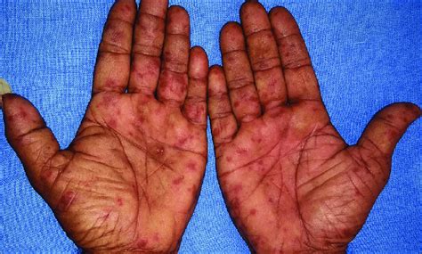Erythematous Macules In The Palms In Hand Foot And Mouth Disease