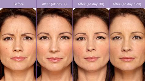 8 Things You Need To Know About Botox