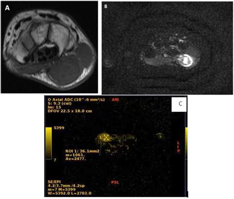 Figure 3 From Mri Supplemented With Diffusion Weighted Image In