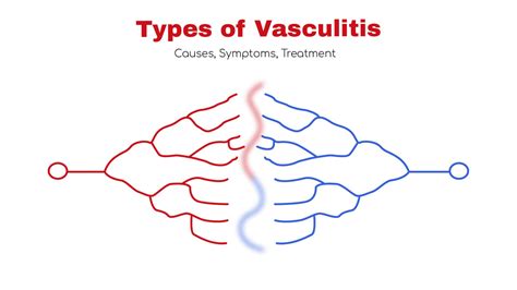 Types Of Vasculitis Symptoms Treatment ~ Statcardiologist