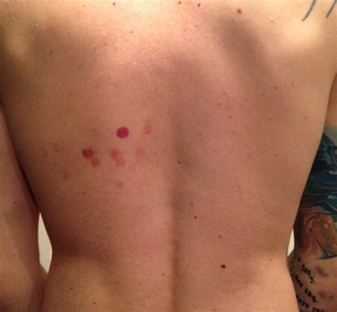 'covid toes' and 'kawasaki' rash: I have the same marks on my back as this photo. I cant feel or notice them but I get them ...