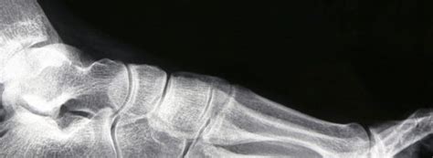 Haglunds Deformity Retrocalcaneal Exostosis Quality Foot Care