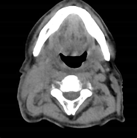 Adenopathy In Left Neck In Head And Neck Tumor Recurrence Ctpet Case