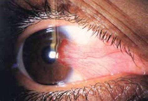 4 Signs Its Time For Pterygium Treatment Marano Eye Care Ophthalmology