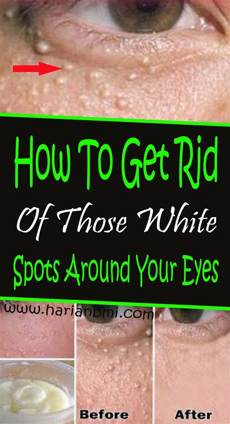 How To Get Rid Of Those White Spots Around Your Eyes