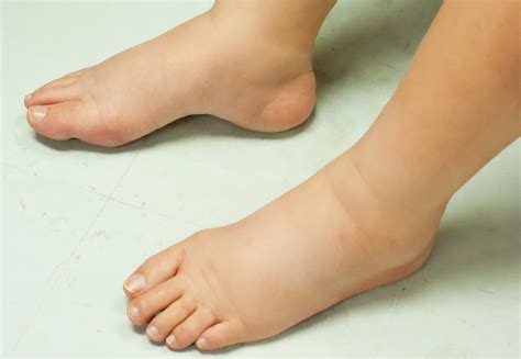 Who Else Wants Info About How To Reduce Swelling Feet Policebaby25