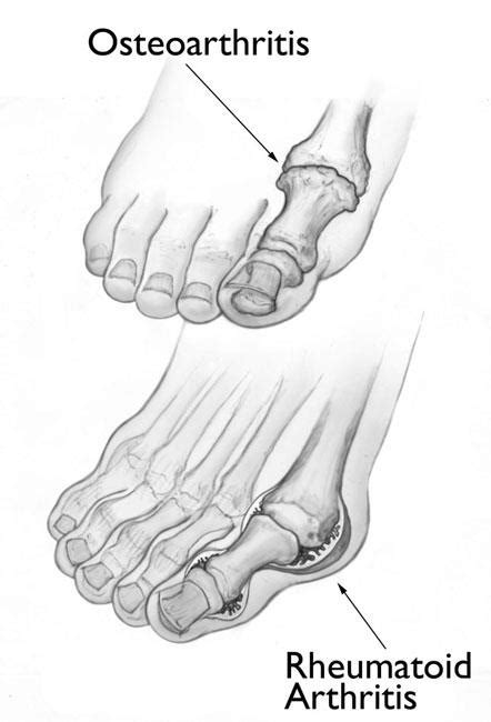 Arthritis Of The Foot And Ankle Orthoinfo Aaos