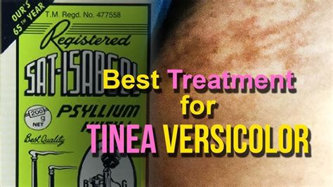 Home Cure For Tinea Versicolor Homemade Ftempo