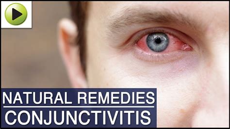 Conjunctivitis Pink Eye Natural Ayurvedic Home Remedies Youtube