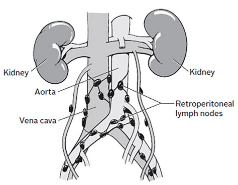 An Overview Of Retroperitoneal Lymph Node Dissection