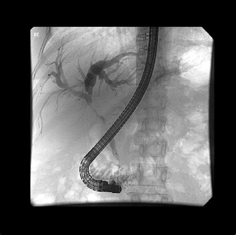 Ercp Of Case 1 Showing A Proximal Cbd Stenosis With Dilatation Of The