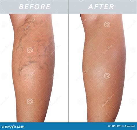 Adult Woman Leg With Varicose Veins Before And After Treatment Stock