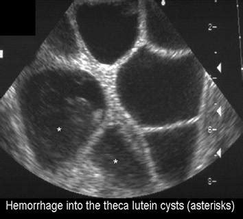 Ultrasound Of Complete Molar Pregnancy