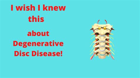 Everything You Need To Know About Degenerative Disc Disease Backpain Spine YouTube