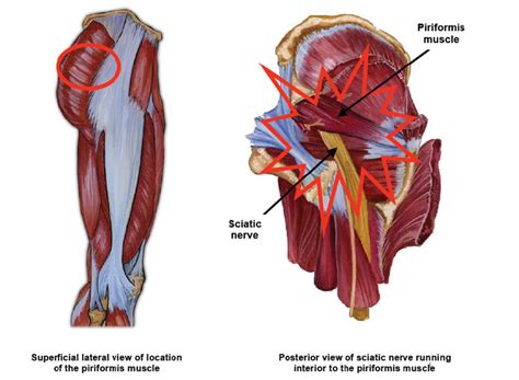 How is piriformis syndrome diagnosed? Yaletown Orthotics Yaletown Orthotics - Piriformis ...