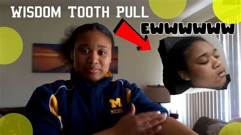 How much is wisdom teeth removal? My Wisdom tooth removal experience - YouTube
