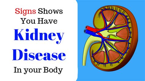 Kidney Disease Early Signs 10 Symptoms That Show In Your Body