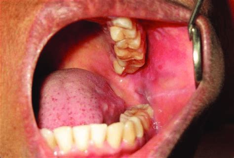 Intra Oral Photograph An Oval Shaped Swelling In The Left Buccal Mucosa
