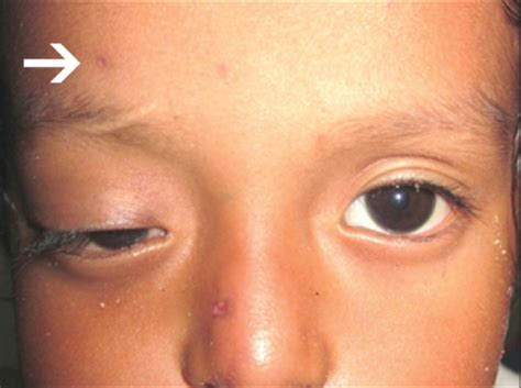 Herpes Zoster Ophthalmicus Presenting As Orbital Abscess Along With
