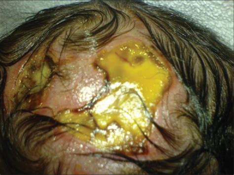Aplasia Cutis Congenita Two Case Reports And Discussion Of The
