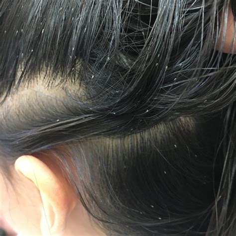 Head Lice On Hair