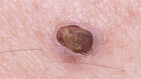 Mr Blackheads Dilated Pore Of Winer Blackhead King Youtube