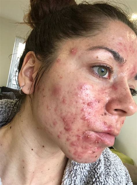 Woman 25 Has To Quit Job As Boils Erupt In Worst Case Of Acne Docs