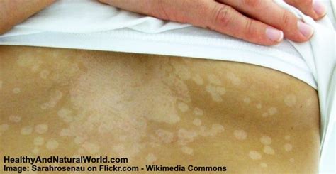 White Spots On Skin Causes And Possible Treatments